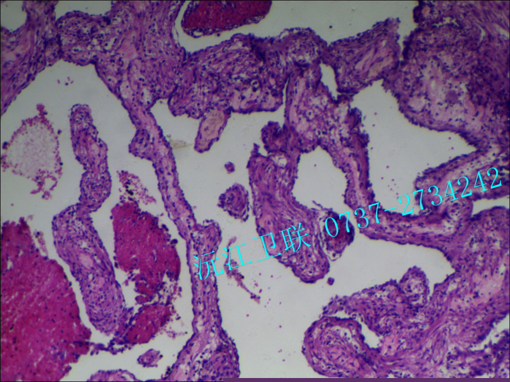非霍奇金淋巴瘤